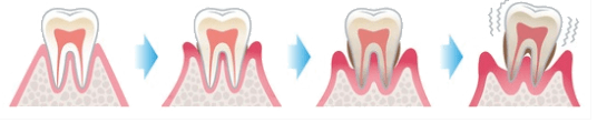 歯周病の進行度合い｜曽根駅前歯科クリニック